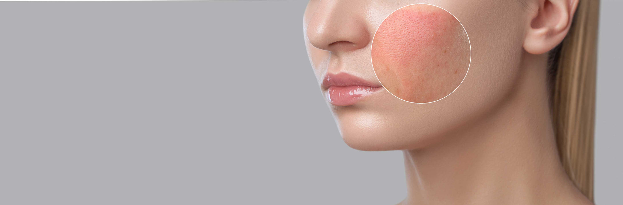 Rosacea: Tips to minimise flare-ups and soothe your skin.
